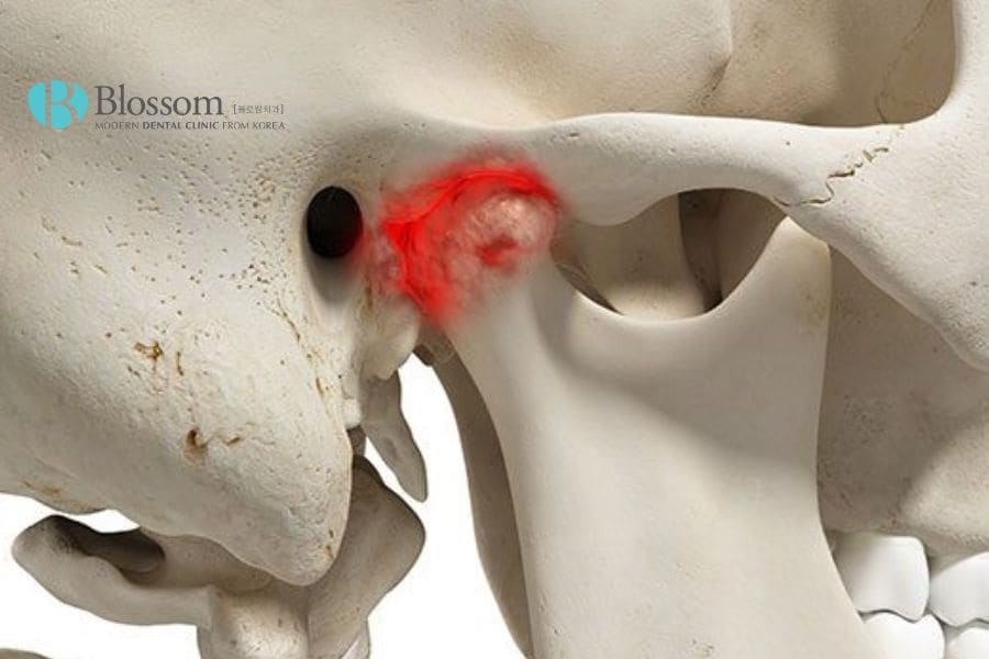 Há miệng có tiếng kêu khớp có nguy hiểm không? Điều trị thế nào hiệu quả? 5 ha mieng co tieng khop keu 4