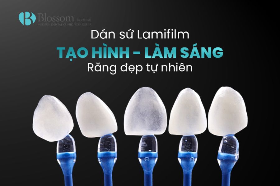 Khi nào tẩy trắng răng? Giải đáp thắc mắc về tẩy trắng răng 8 khi nao tay trang rang 7