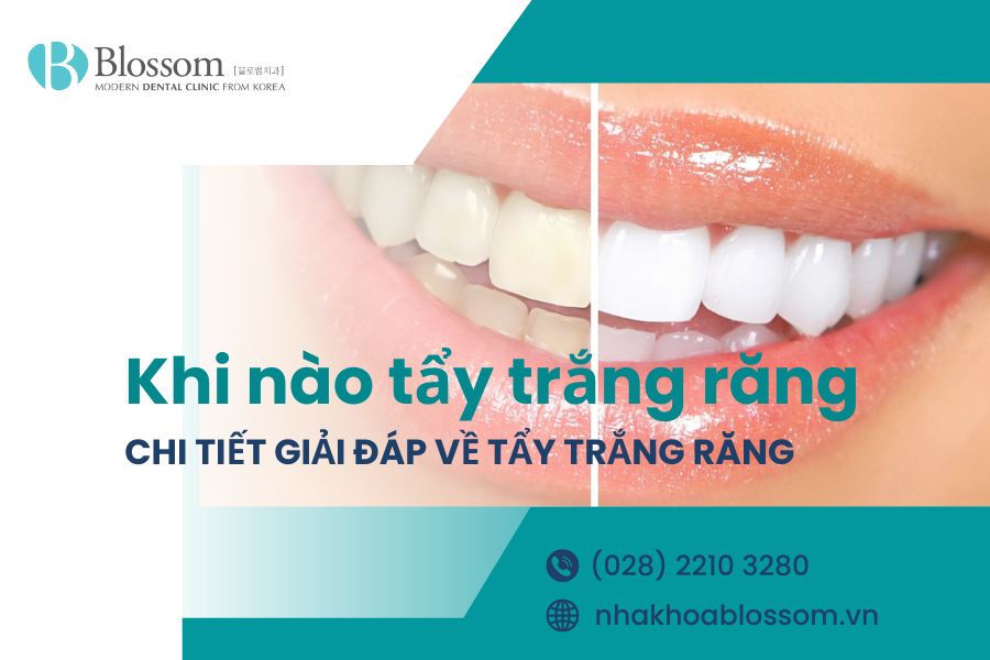 Khi nào tẩy trắng răng? Giải đáp thắc mắc về tẩy trắng răng 1 khi nao tay trang rang