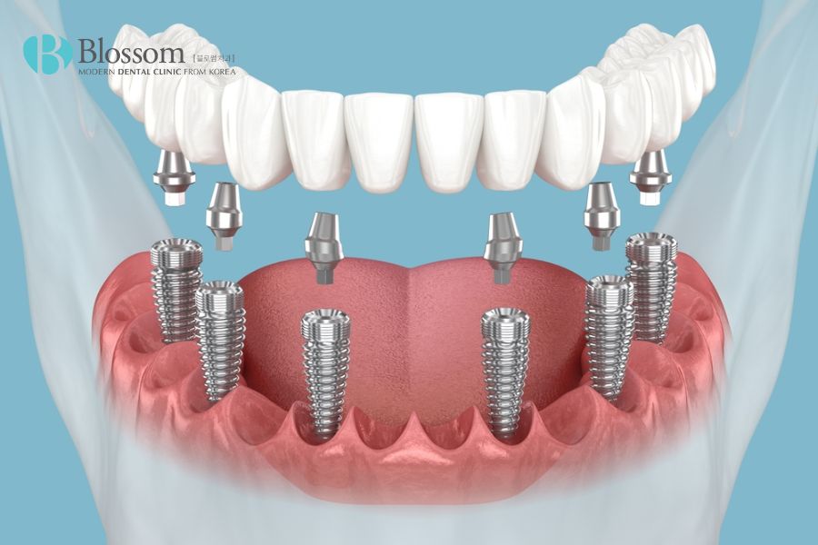 Tổng hợp 9 kinh nghiệm trồng răng Implant hiệu quả 2 kinh nghiem trong rang implant 1