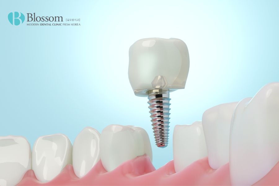 Tổng hợp 9 kinh nghiệm trồng răng Implant hiệu quả 5 kinh nghiem trong rang implant 4
