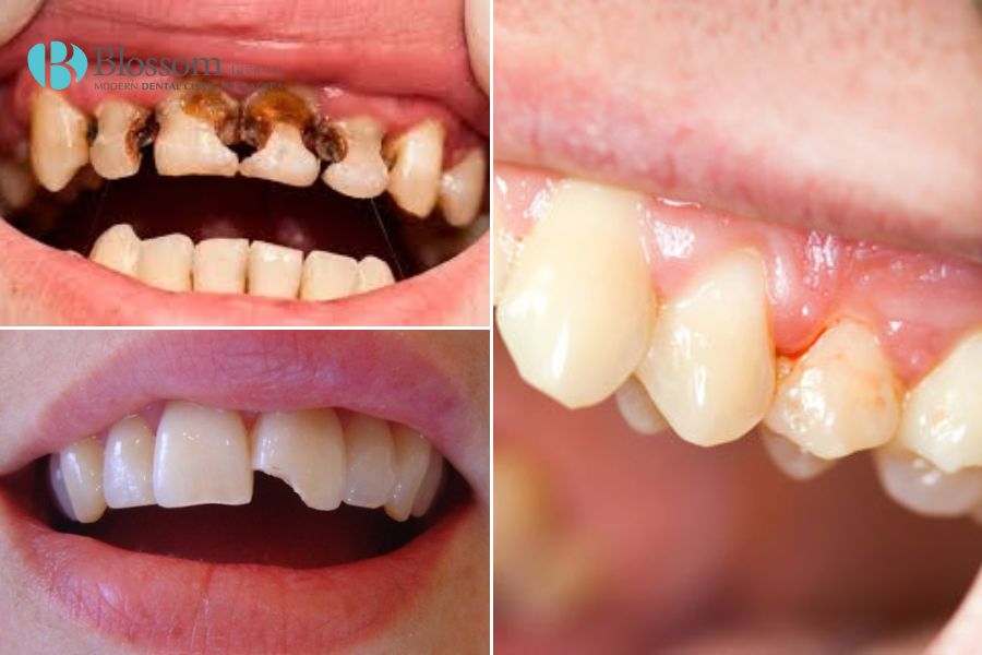 Tổng hợp 9 kinh nghiệm trồng răng Implant hiệu quả 9 kinh nghiem trong rang implant 8