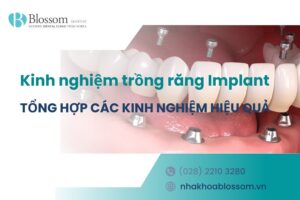 Tổng hợp 9 kinh nghiệm trồng răng Implant hiệu quả