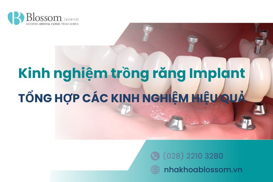 Tổng hợp 9 kinh nghiệm trồng răng Implant hiệu quả