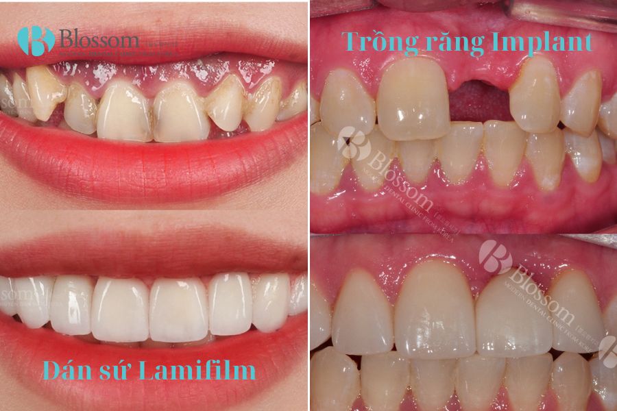 Kỹ thuật trồng răng sứ: Quy trình an toàn, chuẩn xác với 5 bước 7 ky thuat trong rang su 6