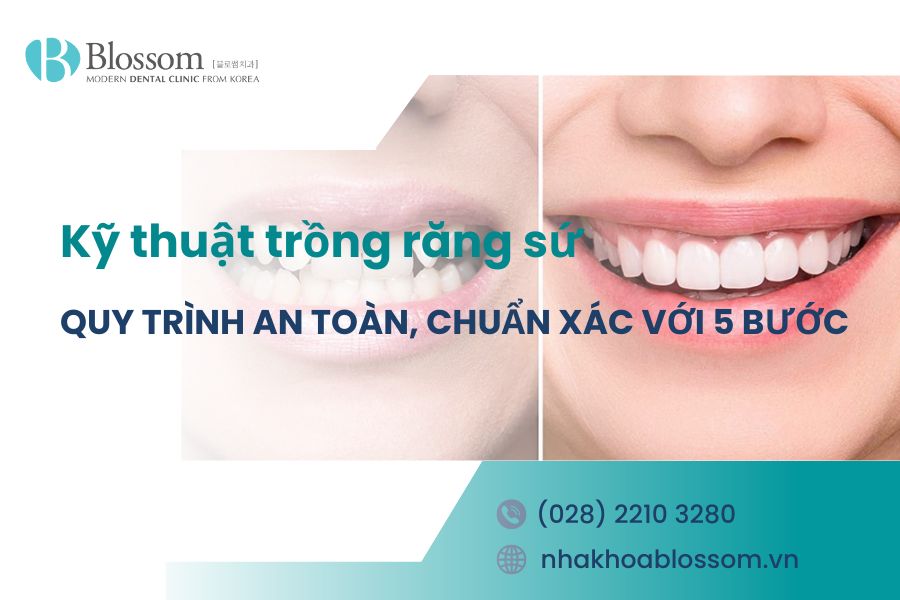 Kỹ thuật trồng răng sứ: Quy trình an toàn, chuẩn xác với 5 bước