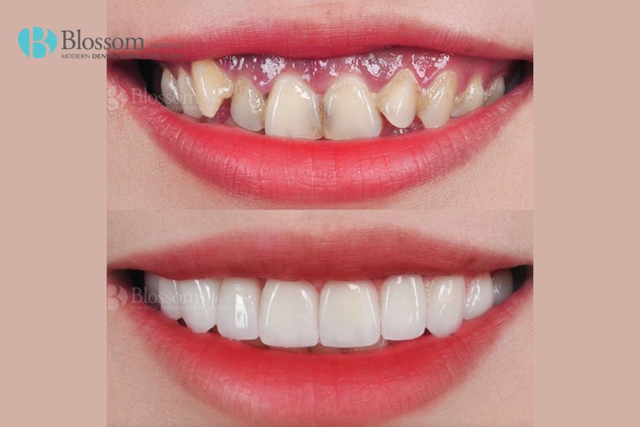 Làm răng sứ không mài có tốt không? Ưu điểm, chi phí và những thông tin cần lưu ý 3 lam rang su khong mai 2 min