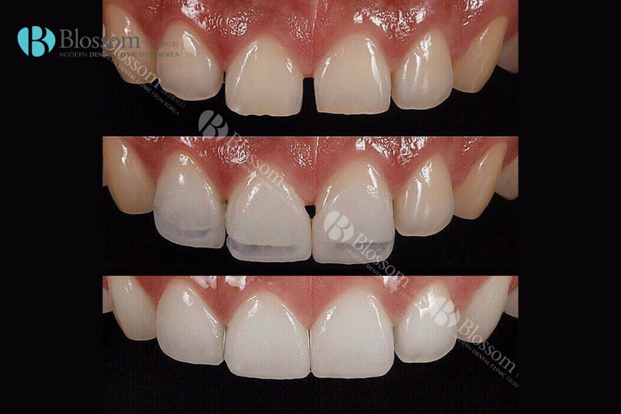 Làm răng sứ không mài có tốt không? Ưu điểm, chi phí và những thông tin cần lưu ý 6 lam rang su khong mai 5 min