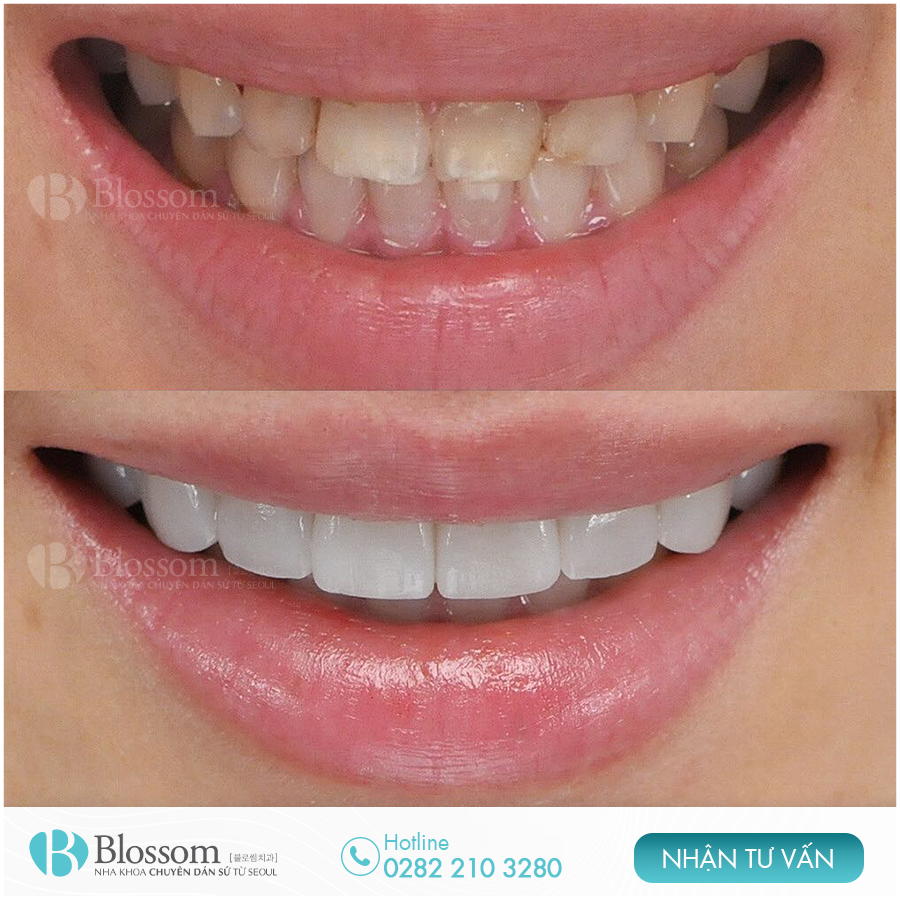 Nụ cười đẹp là như thế nào? Làm thế nào để có nụ cười đẹp? 13 lam the nao de co nu cuoi dep 11