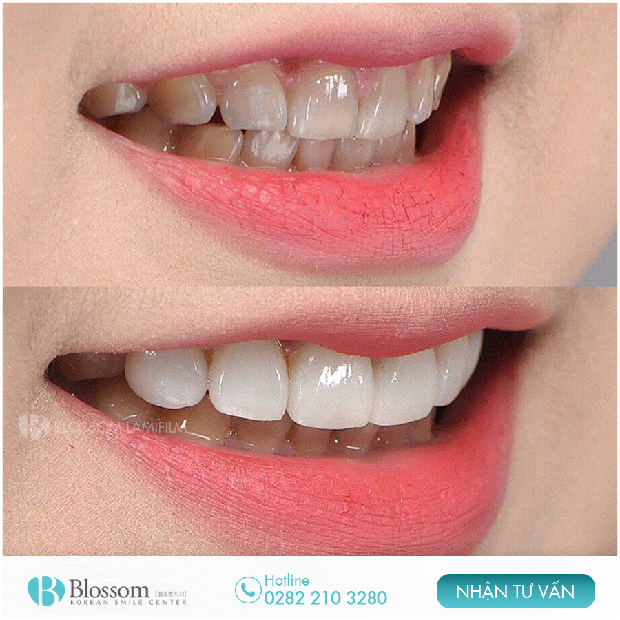 Nụ cười đẹp là như thế nào? Làm thế nào để có nụ cười đẹp? 14 lam the nao de co nu cuoi dep 12