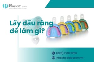 Lấy dấu răng để làm gì? Lợi ích lấy dấu răng