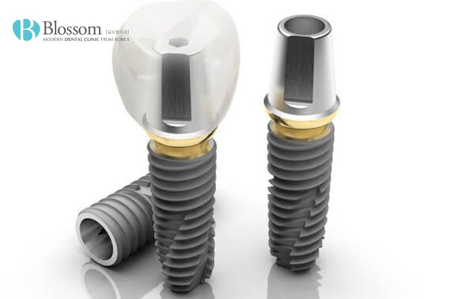 Loại Implant nào là tốt nhất hiện nay? - Nha Khoa Blossom 6 loai implant nao la tot nhat 5