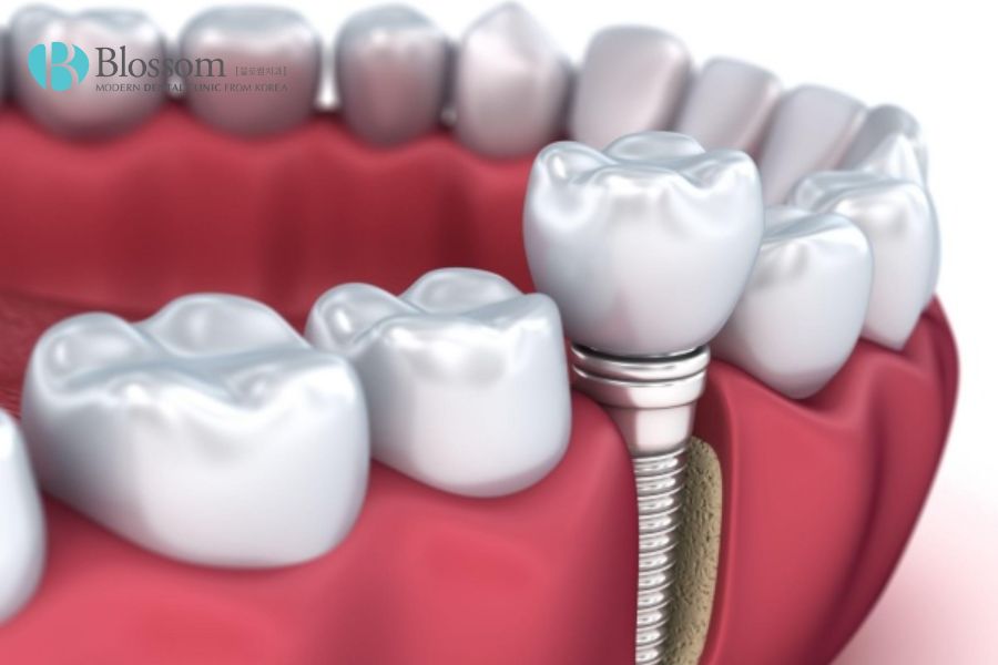 Loại Implant nào là tốt nhất hiện nay? - Nha Khoa Blossom 8 loai implant nao la tot nhat 7