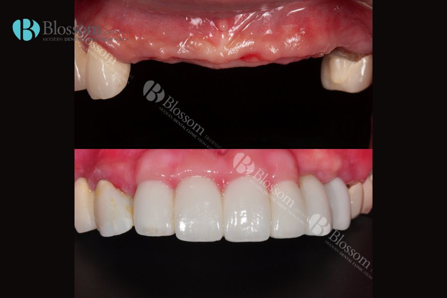 Loại Implant nào là tốt nhất hiện nay? - Nha Khoa Blossom 10 loai implant nao la tot nhat 9