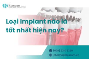 Loại Implant nào là tốt nhất hiện nay? – Nha Khoa Blossom