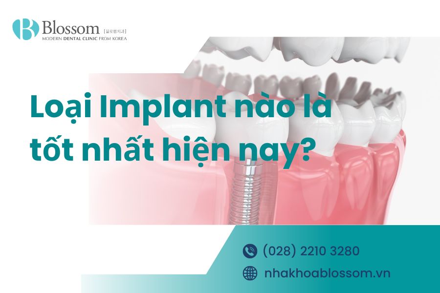 Loại Implant nào là tốt nhất hiện nay? – Nha Khoa Blossom