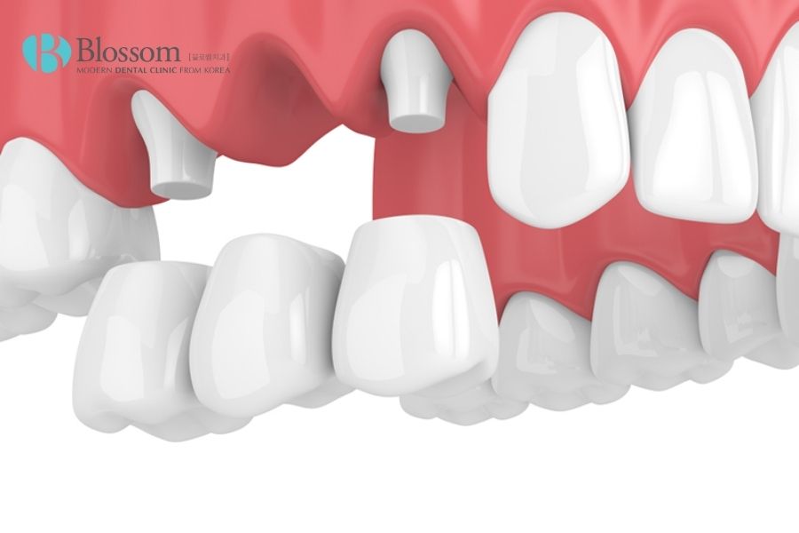 Mài răng bọc sứ có đau không? Có ảnh hưởng gì không? 3 mai rang boc su 2