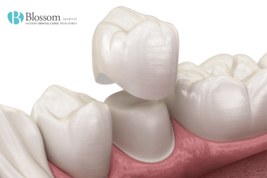 Mài răng bọc sứ có đau không? Có ảnh hưởng gì không? 4 mai rang boc su 3