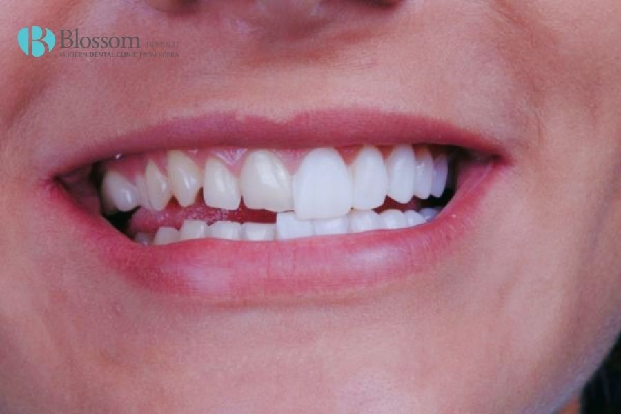 Mài răng bọc sứ có đau không? Có ảnh hưởng gì không? 6 mai rang boc su 5