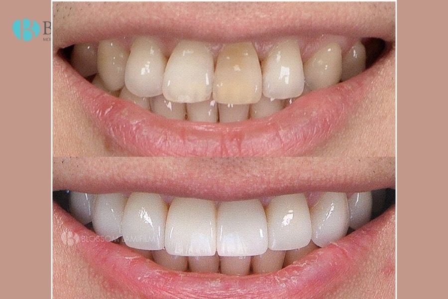 Mài răng bọc sứ có đau không? Có ảnh hưởng gì không? 7 mai rang boc su 6