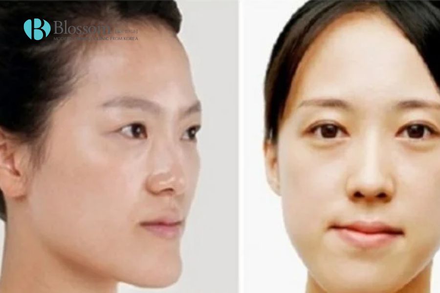 Mặt lệch bên cao bên thấp là tình trạng gì? Có thể khắc phục không? 3 mat lech ben cao ben thap 2