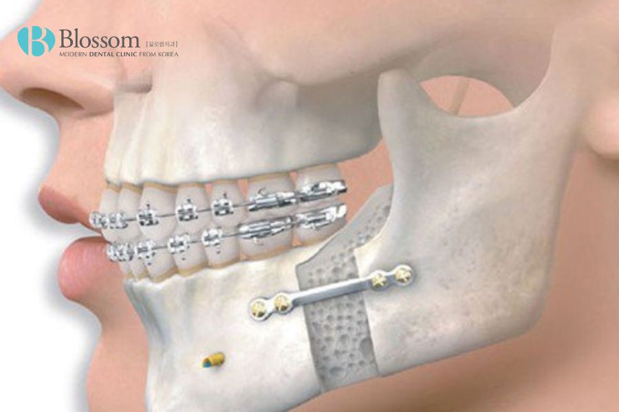 Mặt lệch bên cao bên thấp là tình trạng gì? Có thể khắc phục không? 8 mat lech ben cao ben thap 7