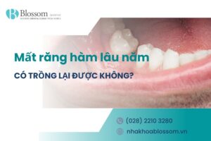 [Giải đáp] Mất răng hàm lâu năm có trồng lại được không?