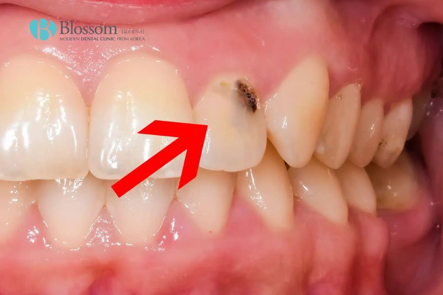 Tìm hiểu chi tiết các mức độ sâu răng trong nha khoa 2 muc do sau rang 1