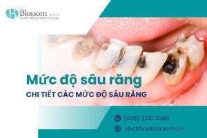 Tìm hiểu chi tiết các mức độ sâu răng trong nha khoa