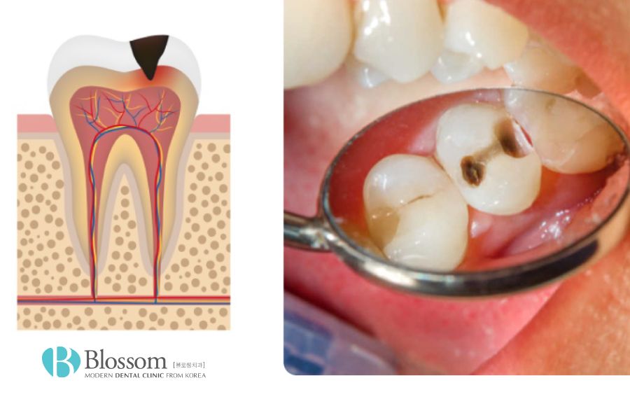Tìm hiểu chi tiết các mức độ sâu răng trong nha khoa 5 muc do sau rang 4