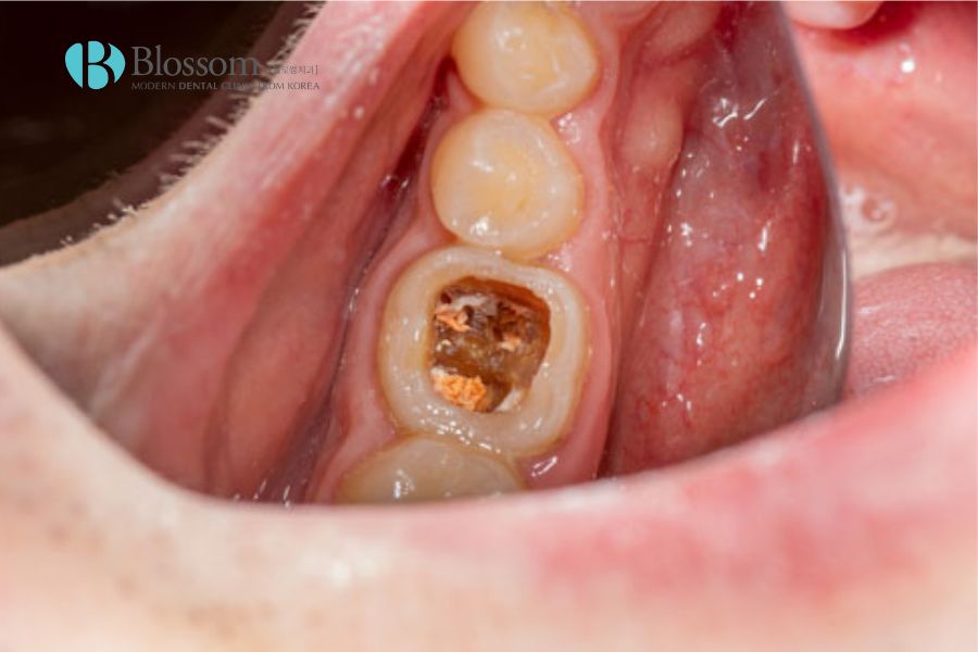 Tìm hiểu chi tiết các mức độ sâu răng trong nha khoa 6 muc do sau rang 5