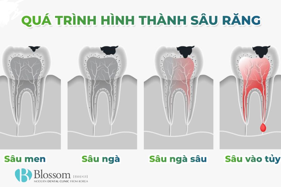 Tìm hiểu chi tiết các mức độ sâu răng trong nha khoa 7 muc do sau rang 8