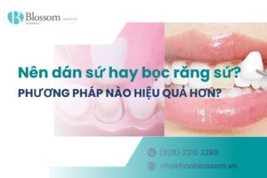 Nên dán sứ hay bọc răng sứ? Phương pháp nào hiệu quả hơn?