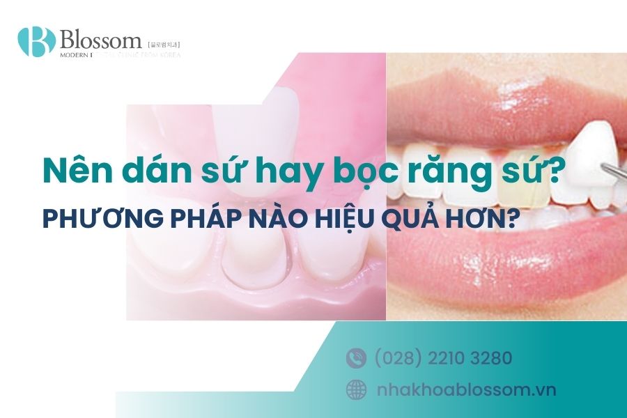 Nên dán sứ hay bọc răng sứ? Phương pháp nào hiệu quả hơn?