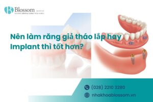 [Giải đáp] Nên làm răng giả tháo lắp hay Implant thì tốt hơn?