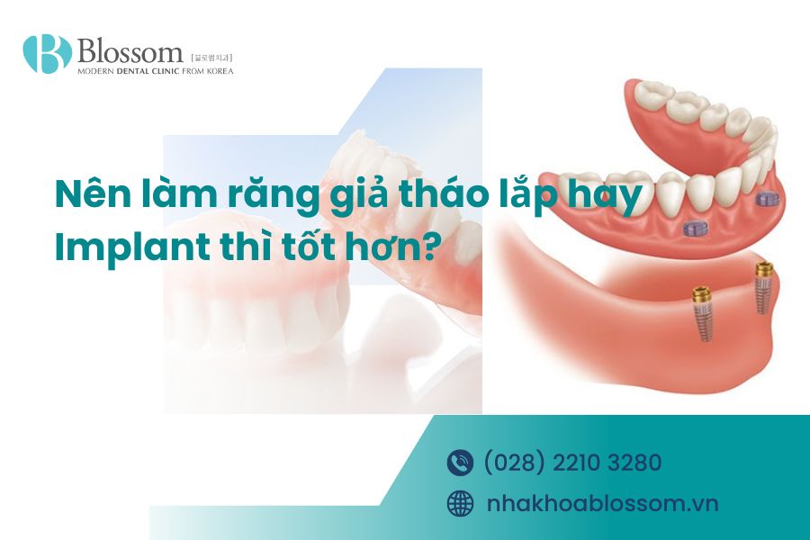 [Giải đáp] Nên làm răng giả tháo lắp hay Implant thì tốt hơn?
