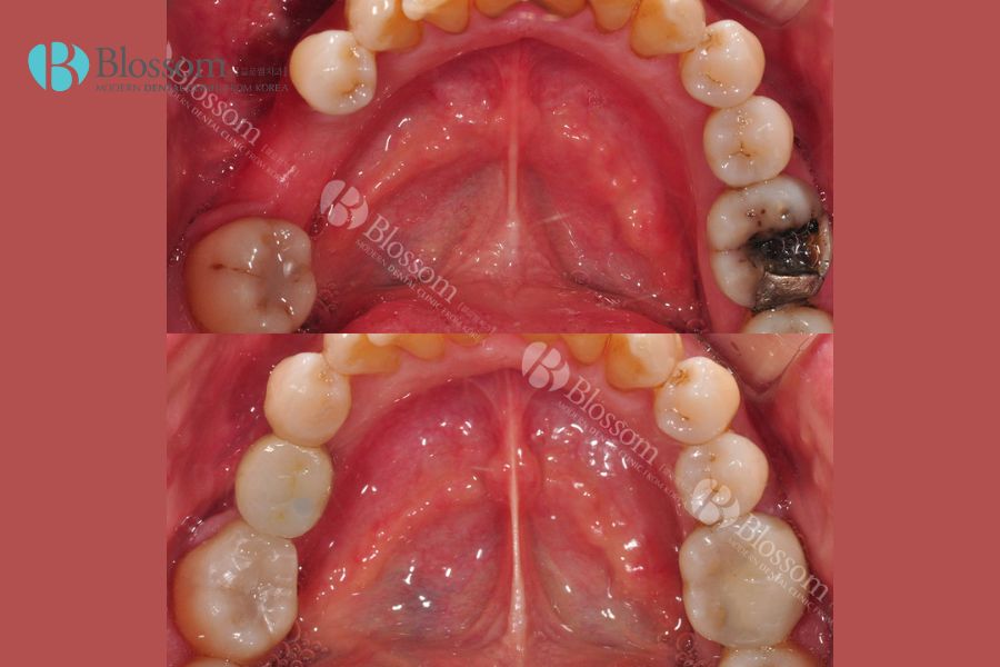 nen trong rang su hay implant 4