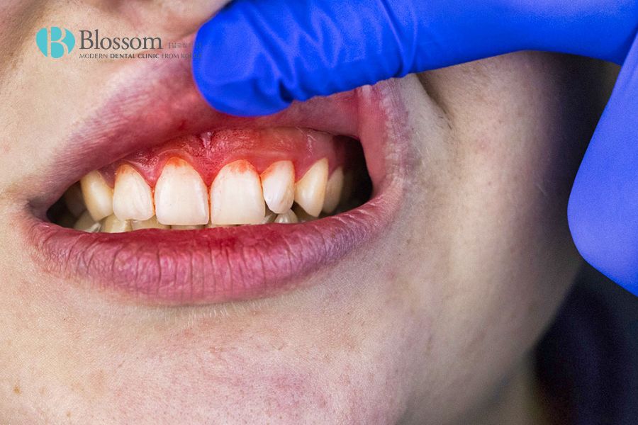 Nguyên nhân nhức răng do đâu? Phương pháp điều trị là gì? 6 nguyen nhan nhuc rang 4