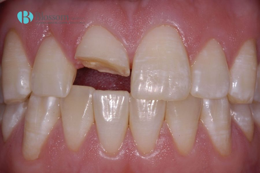 Nguyên nhân nhức răng do đâu? Phương pháp điều trị là gì? 7 nguyen nhan nhuc rang 5