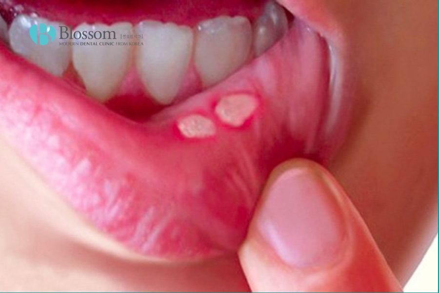 Nhiệt miệng là gì? Nhiệt miệng nên ăn gì? 2 nhiet mieng nen an gi 2