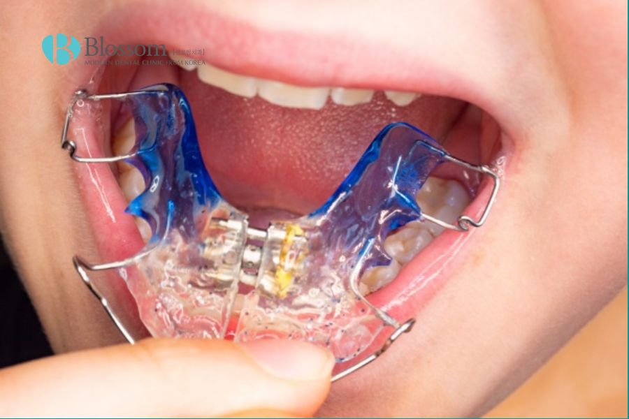 Nong hàm là gì? Đối tượng nào cần thực hiện? 7 nong ham la gi 7