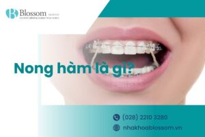 Nong hàm là gì? Đối tượng nào cần thực hiện?