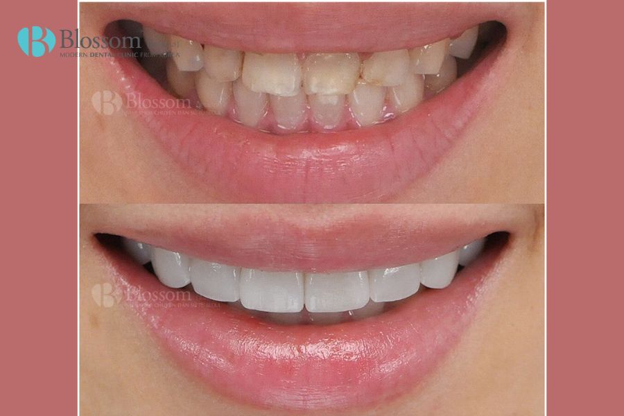Phân biệt dán sứ Veneer và Lamifilm: Loại nào tốt hơn? 3 phan biet dan su veneer va lamifilm 2