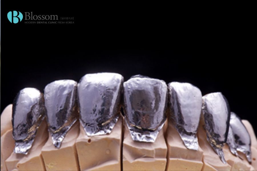 Phân biệt dán sứ Veneer và Lamifilm: Loại nào tốt hơn? 4 phan biet dan su veneer va lamifilm 3