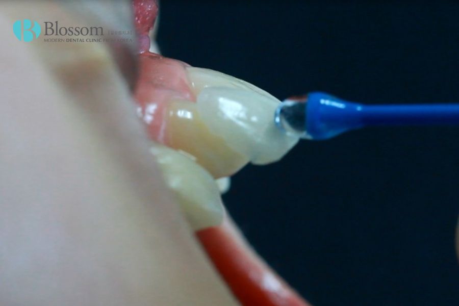 Phân biệt dán sứ Veneer và Lamifilm: Loại nào tốt hơn? 5 phan biet dan su veneer va lamifilm 4