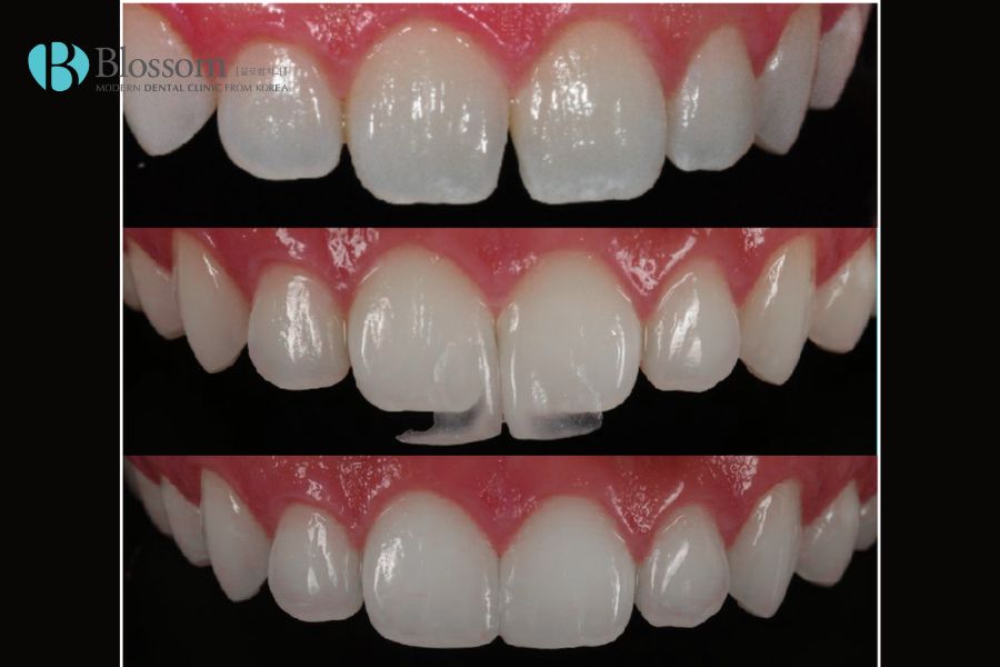 Phân biệt dán sứ Veneer và Lamifilm: Loại nào tốt hơn? 6 phan biet dan su veneer va lamifilm 5