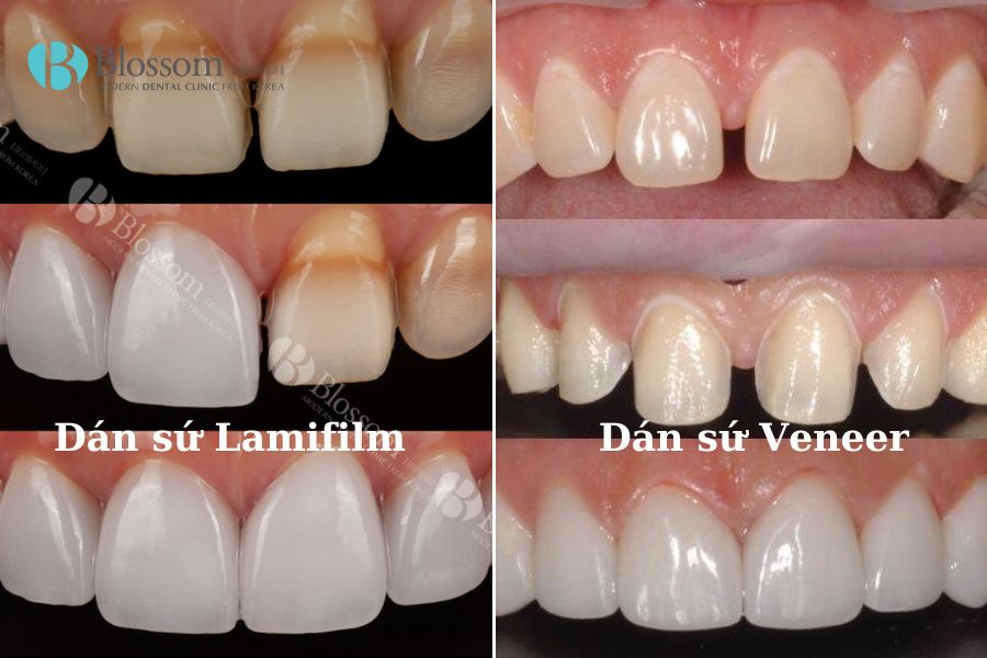 Phân biệt dán sứ Veneer và Lamifilm: Loại nào tốt hơn? 7 phan biet dan su veneer va lamifilm 6