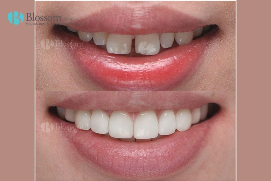 Phân biệt dán sứ Veneer và Lamifilm: Loại nào tốt hơn? 8 phan biet dan su veneer va lamifilm 7