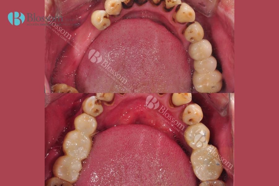 Hướng dẫn quy trình cắm Implant chi tiết, chuẩn Y khoa 13 quy trinh cam implant 12