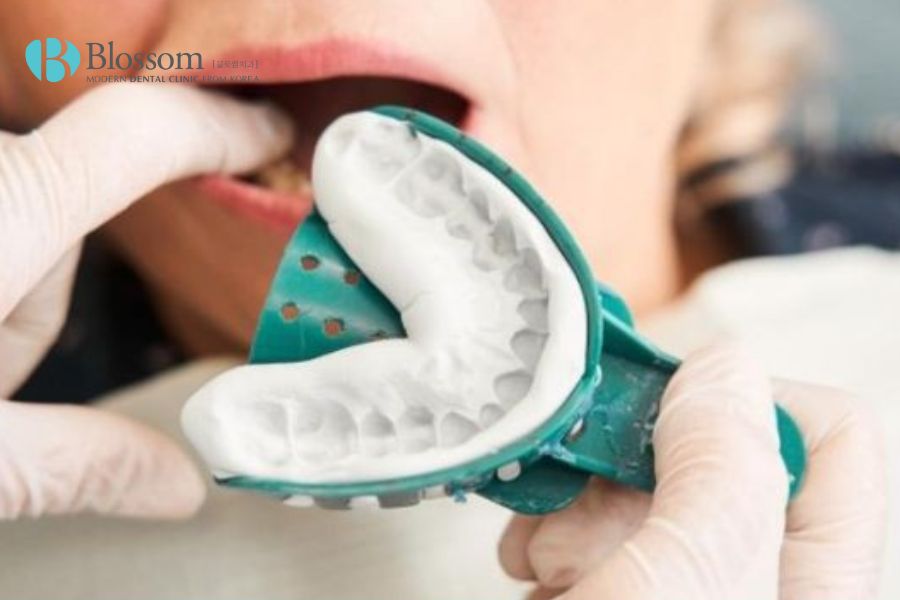 Hướng dẫn quy trình cắm Implant chi tiết, chuẩn Y khoa 5 quy trinh cam implant 4